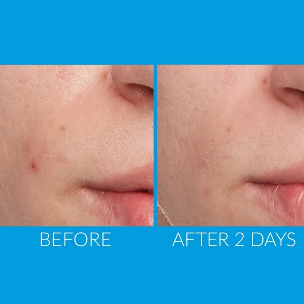 ✨Kate Somerville ERADIKATE® ACNE TREATMENT